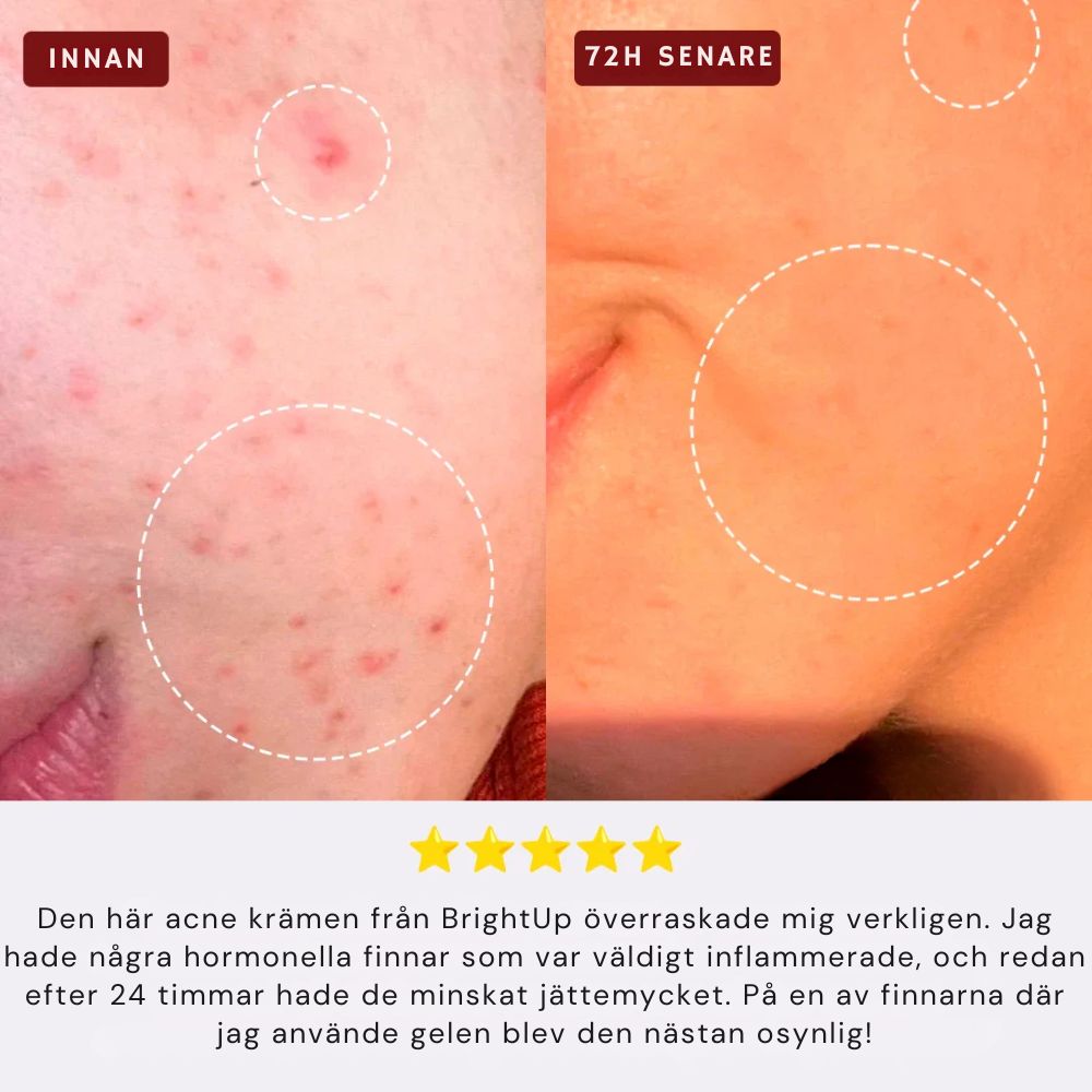 BrightUp Acne Remover