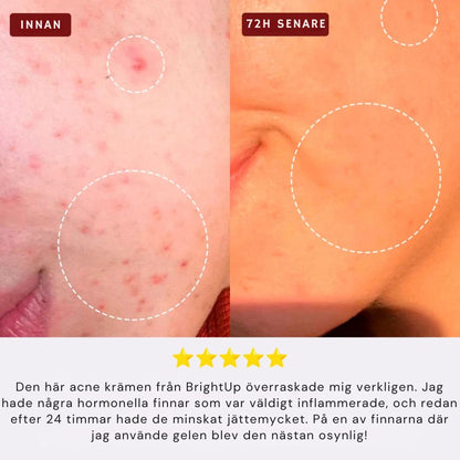BrightUp Acne Remover