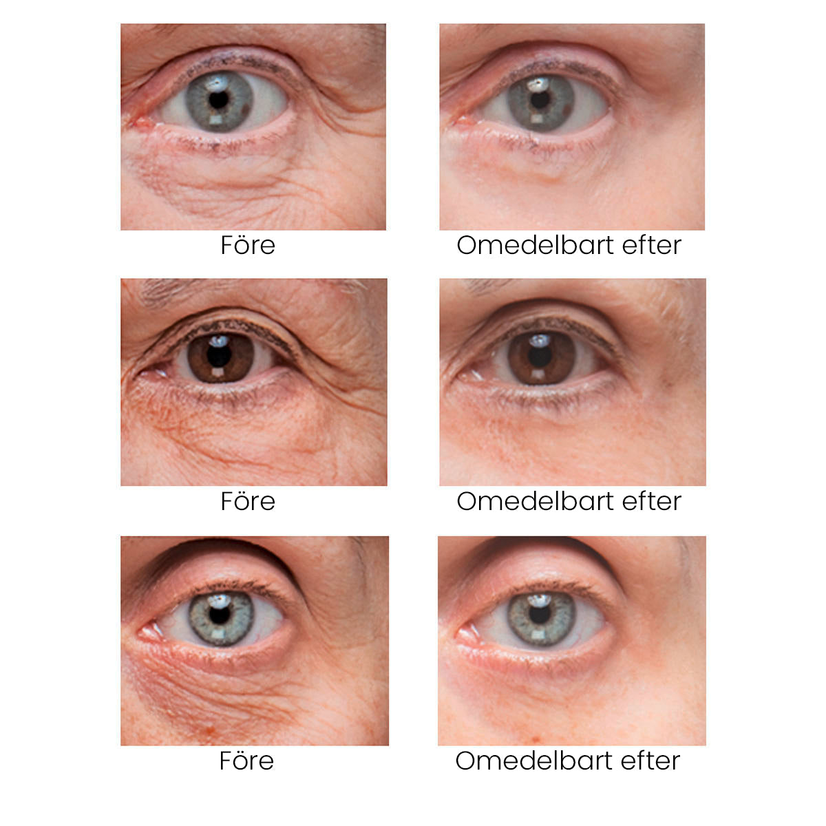 BrightUp - Instant Eye Tightener